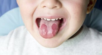 Geographic Tongue, Apa Itu dan Bagaimana Perawatannya?