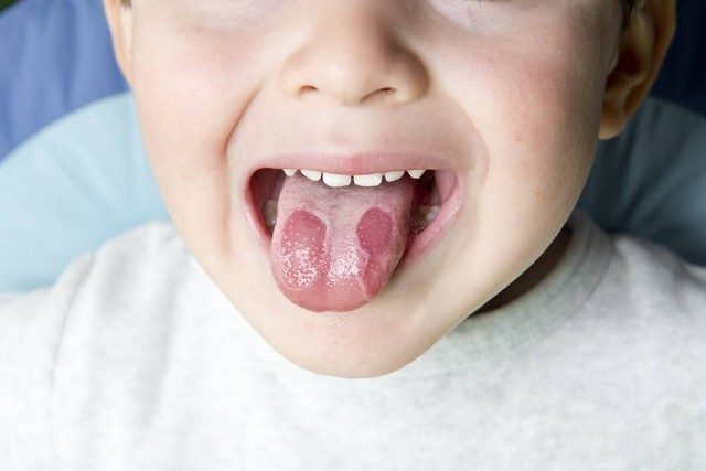 geographic tongue